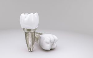 Precio de los implantes dentales - My Dentist Kids