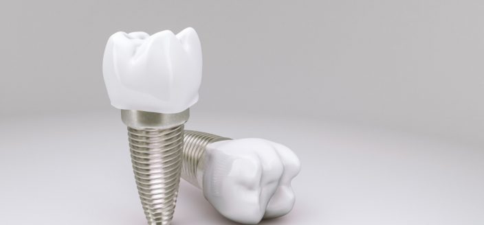 Precio de los implantes dentales - My Dentist Kids