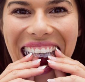 Beneficios de Invisalign