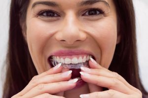 Beneficios de Invisalign